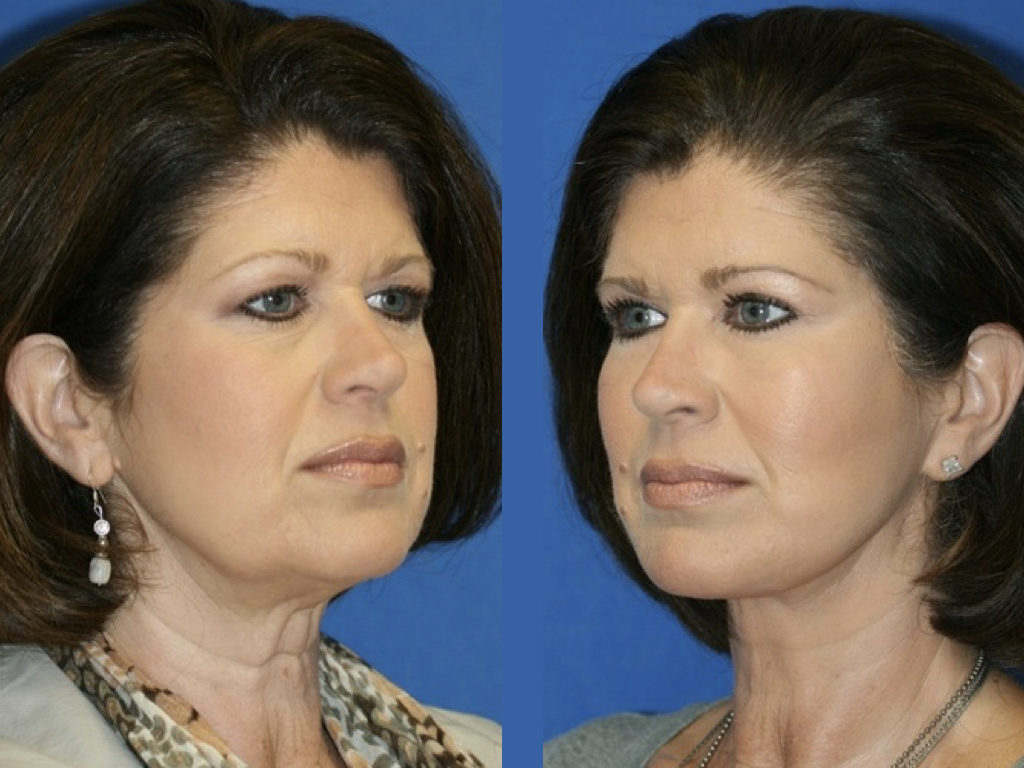 Resultado De Blefaroplastia Y Lifting | Dr Samuel Benarroch