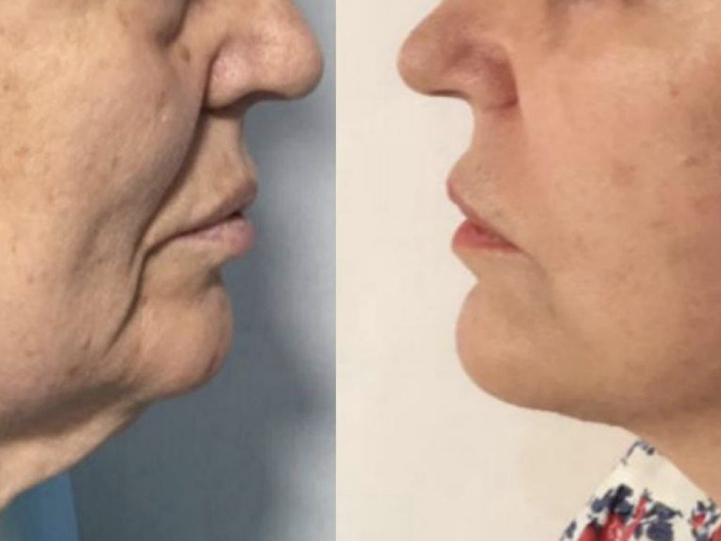 Antes Y Despu S Rejuvenecimiento Facial Dr Samuel Benarroch